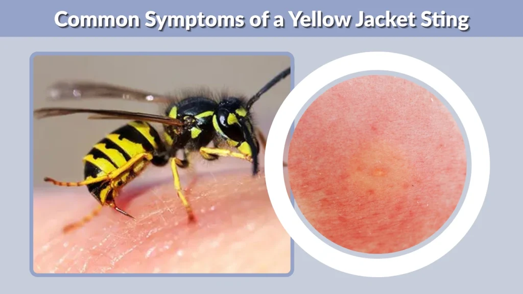 Common Symptoms of a Yellow Jacket Sting