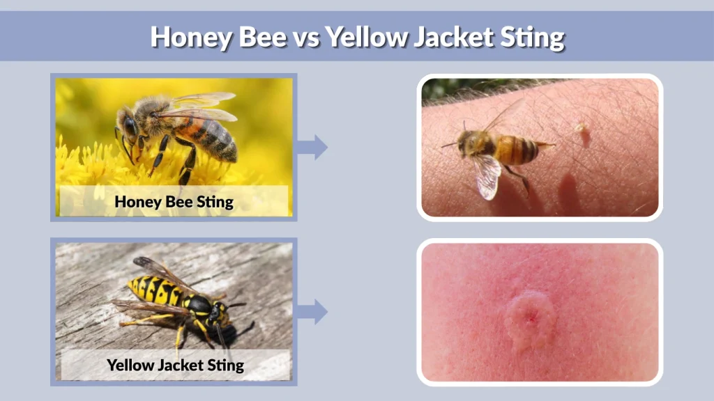 Honey Bee vs Yellow Jacket Sting
