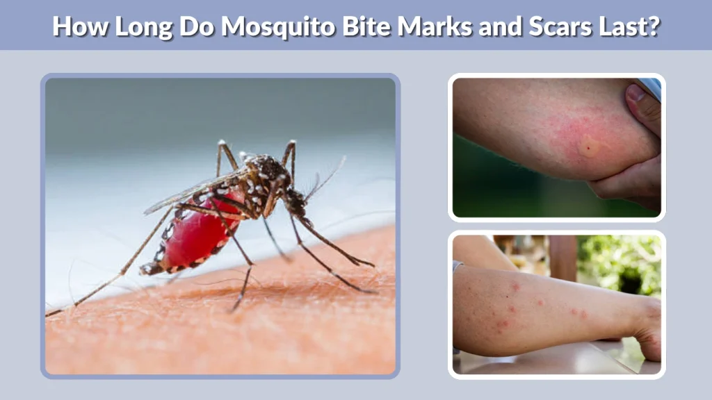 How Long Do Mosquito Bite Marks and Scars Last