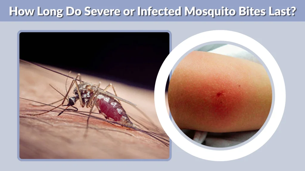 How Long Do Severe or Infected Mosquito Bites Last