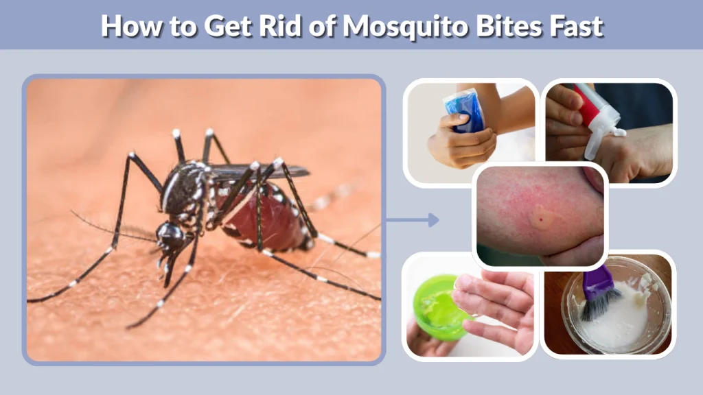 How to Get Rid of Mosquito Bites Fast