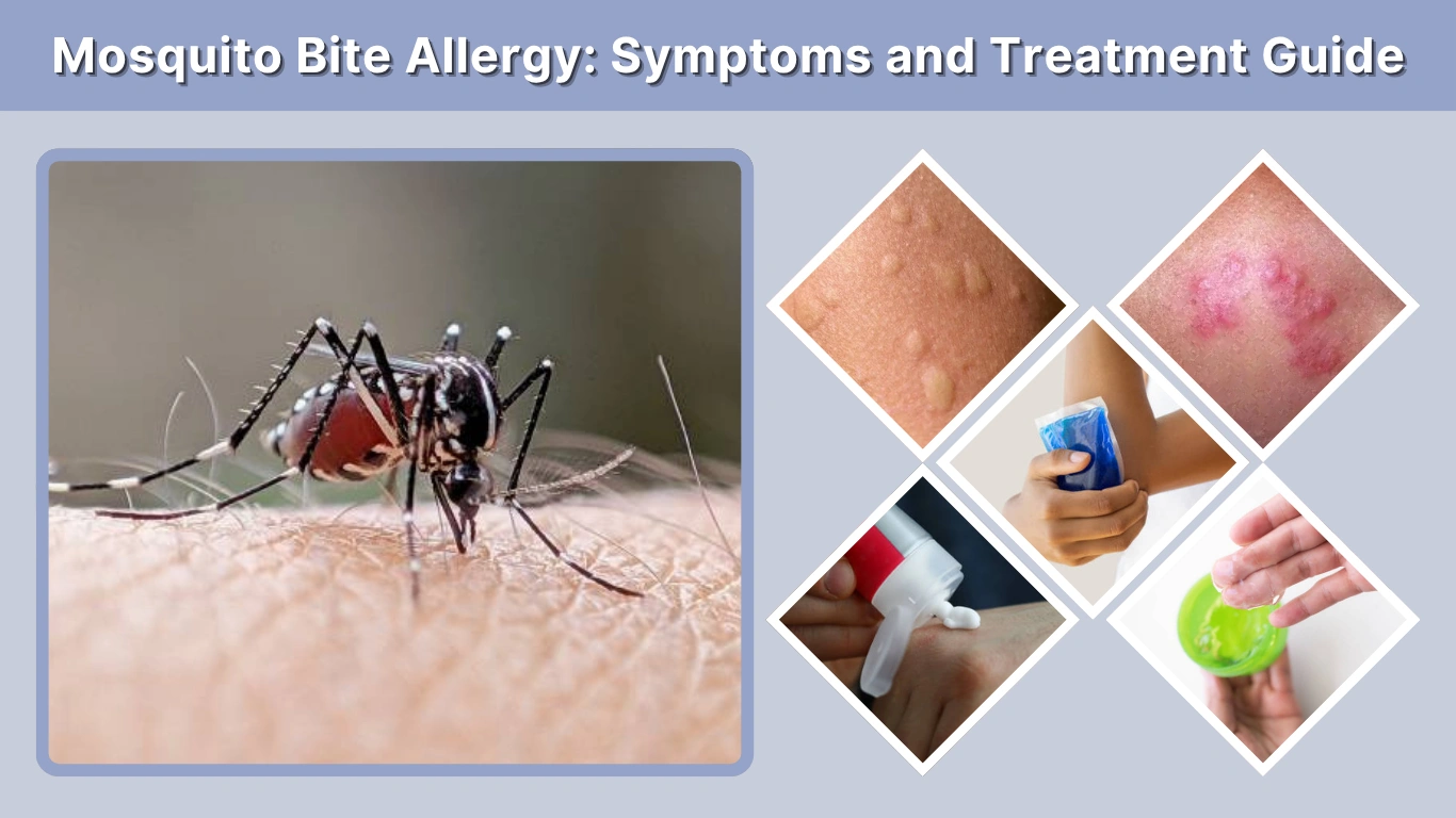Mosquito Bite Allergy Symptoms and Treatment Guide