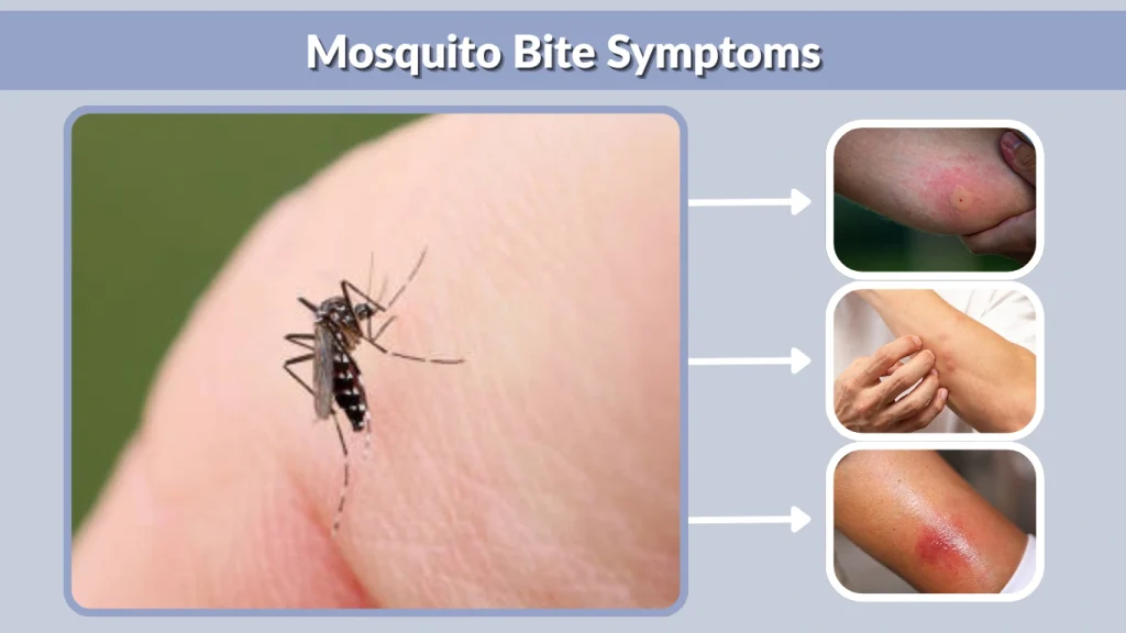 Mosquito Bite Symptoms