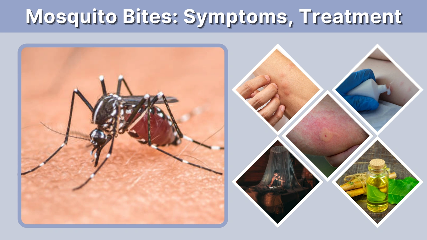 Mosquito Bites Symptoms, Treatment & Prevention Guide