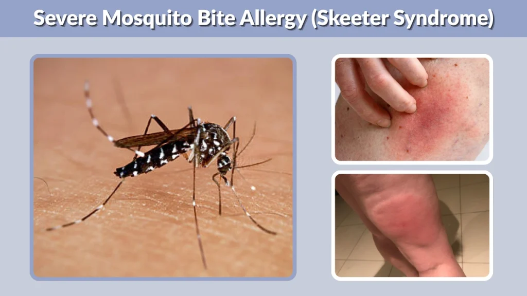 Mosquito Bite Allergy Symptoms And Treatment Guide Mosquito Bite Allergy Symptoms And Treatment Guide