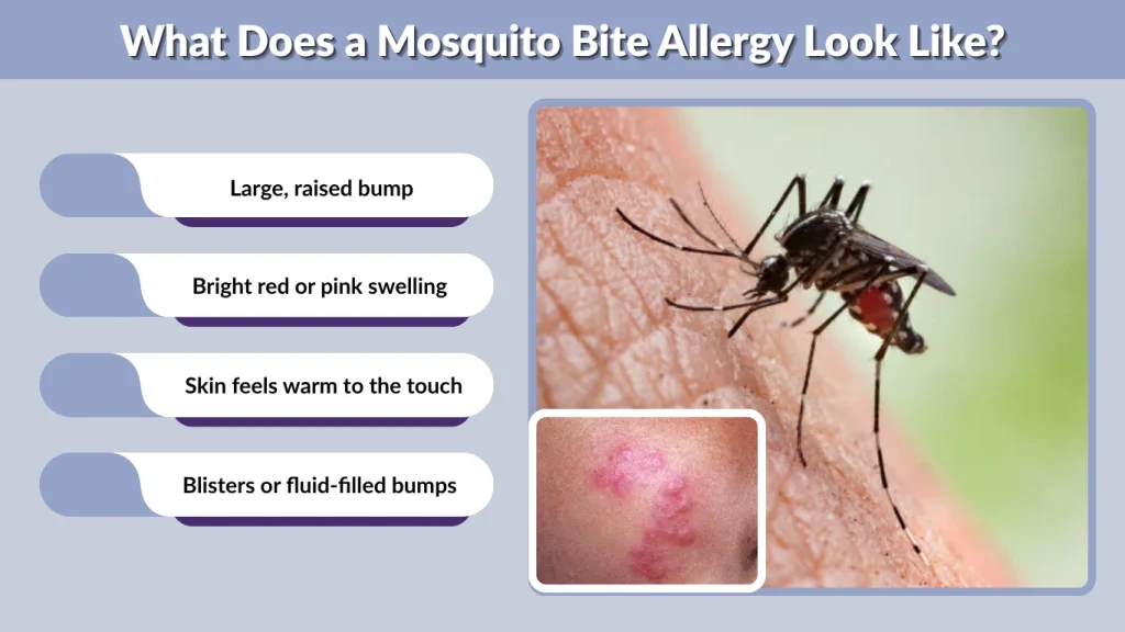 What Does a Mosquito Bite Allergy Look Like