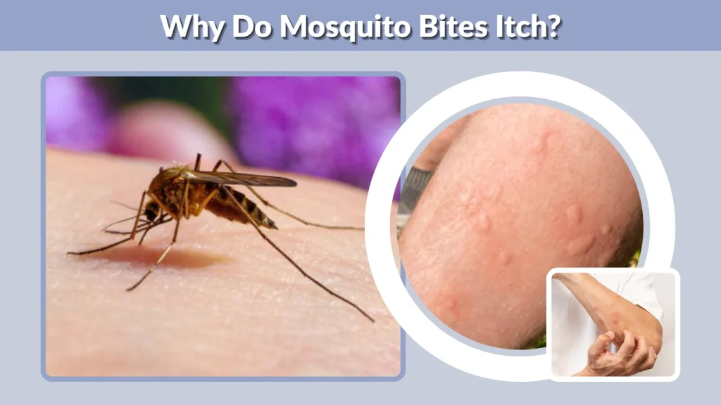 Why Do Mosquito Bites Itch