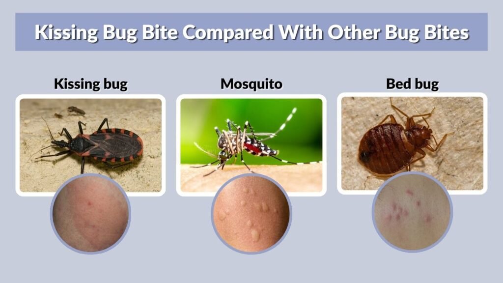 Kissing Bug Bite Compared With Other Bug Bites