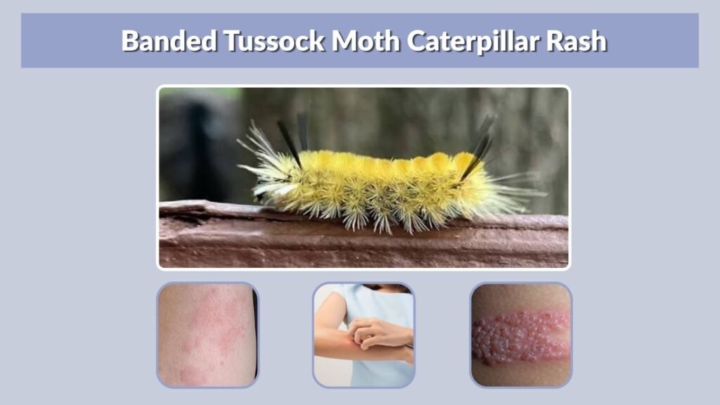 Banded Tussock Moth Caterpillar Rash