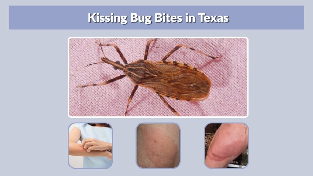 Kissing Bug Bites in Texas