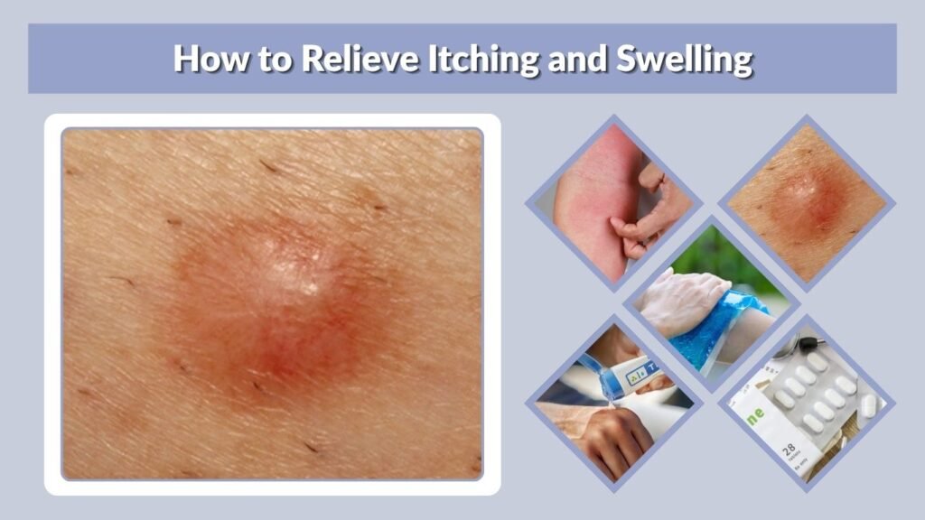 How to Relieve Itching and Swelling