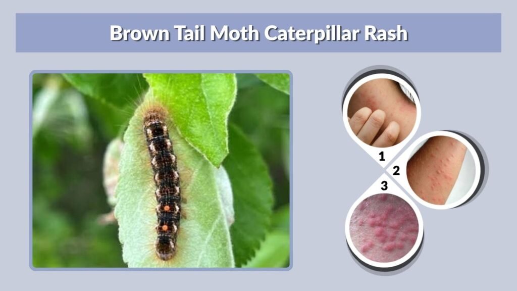 Brown Tail Moth Caterpillar Rash