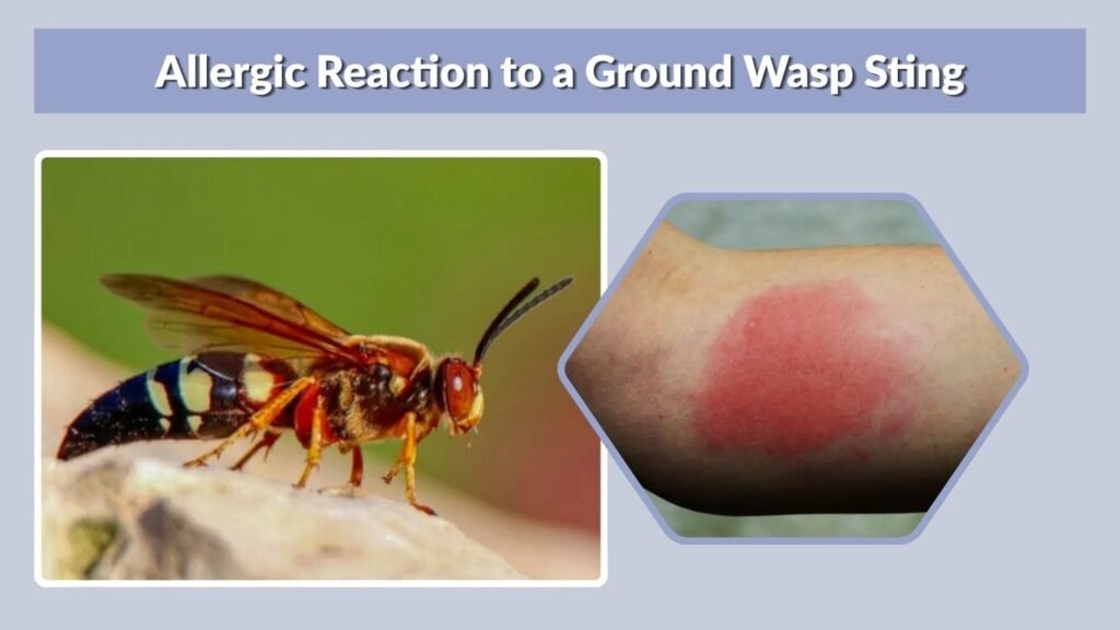 Allergic Reaction to a Ground Wasp Sting