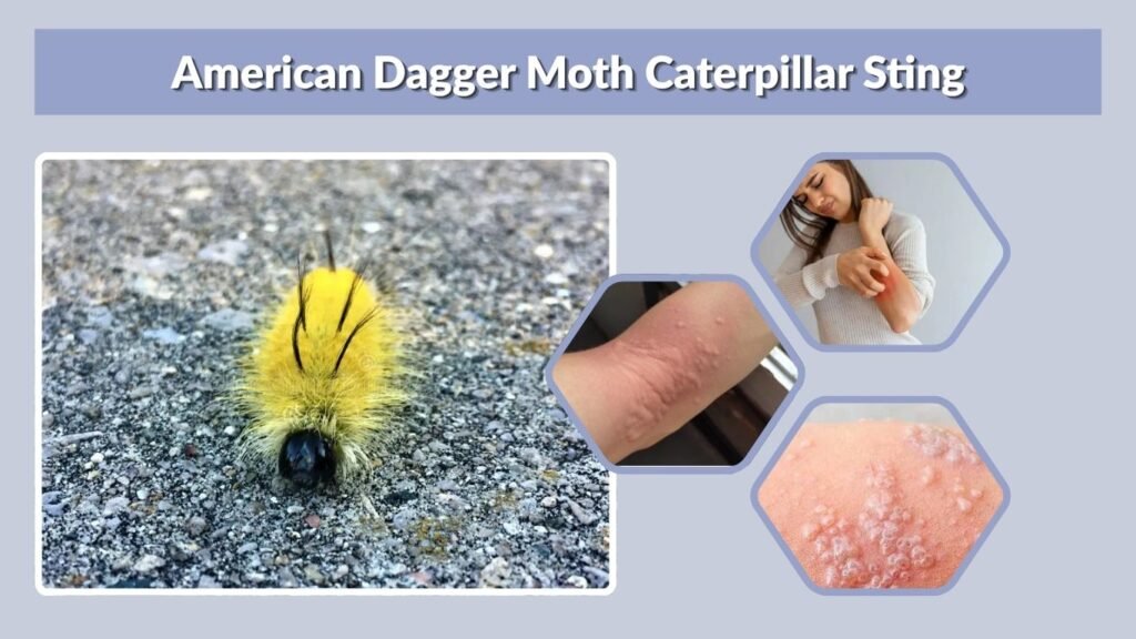 American Dagger Moth Caterpillar Sting