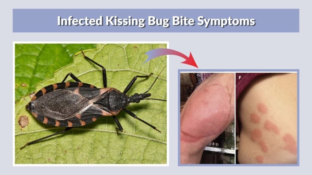 Infected Kissing Bug Bite Symptoms