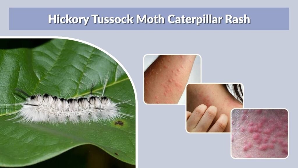 Hickory Tussock Moth Caterpillar Rash
