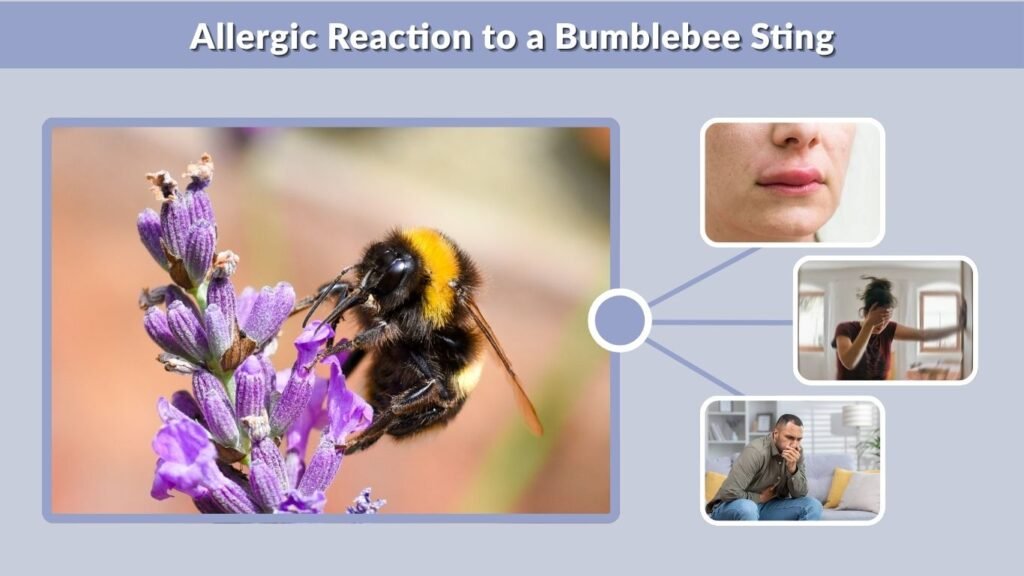 Allergic Reaction to a Bumblebee Sting
