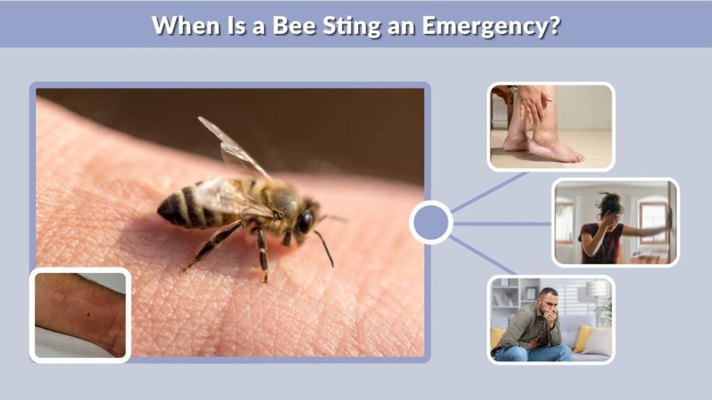 When Is a Bee Sting an Emergency?