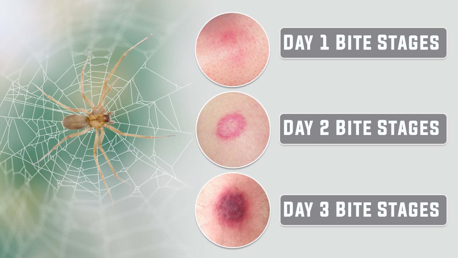 Symptoms And Stages Of A Brown Recluse Spider Bite Ti - vrogue.co