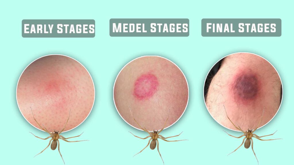 Brown Recluse Spider Bite Early Stages to final stages