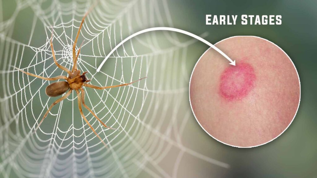 brown-recluse-spider-bite-stages