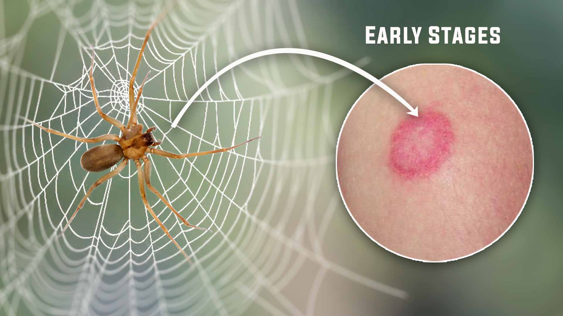 Brown Recluse Spider Bite Pictures Early Stages