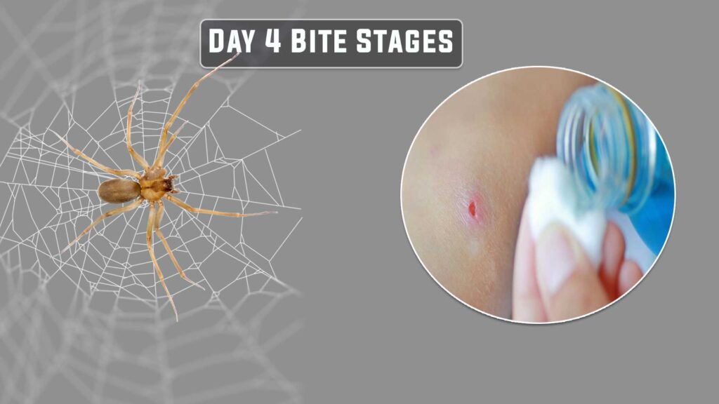 Day 4 Brown recluse bite stages