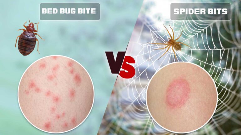Spider Bite vs Bed Bug Bite