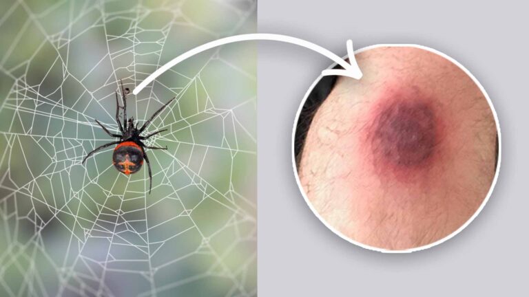 When To Worry About A Spider Bite? (Need to Know)