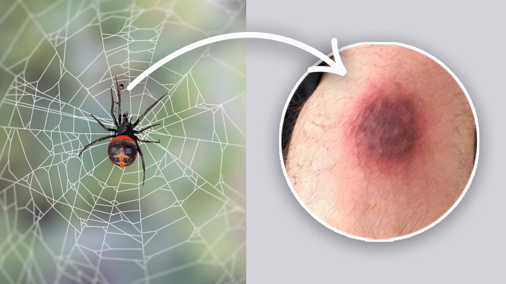When To Worry About A Spider Bite