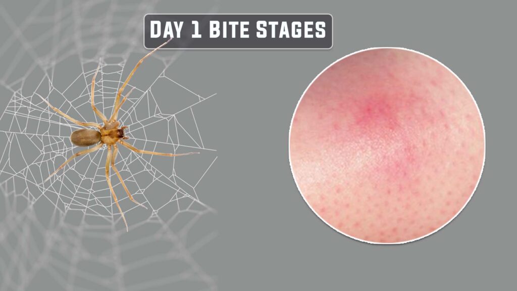 day 1 brown recluse bite stages