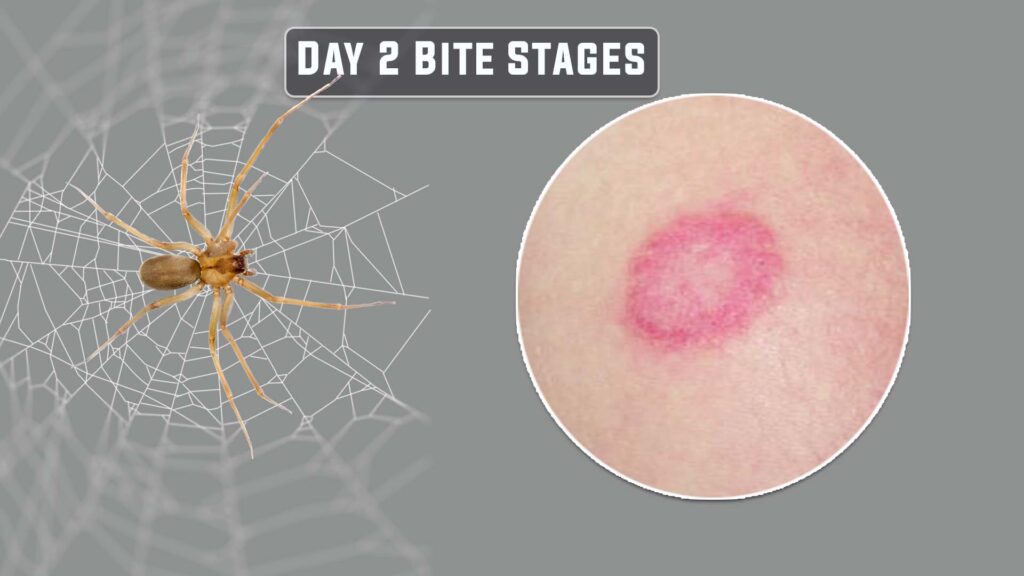 day 2 brown recluse bite stages