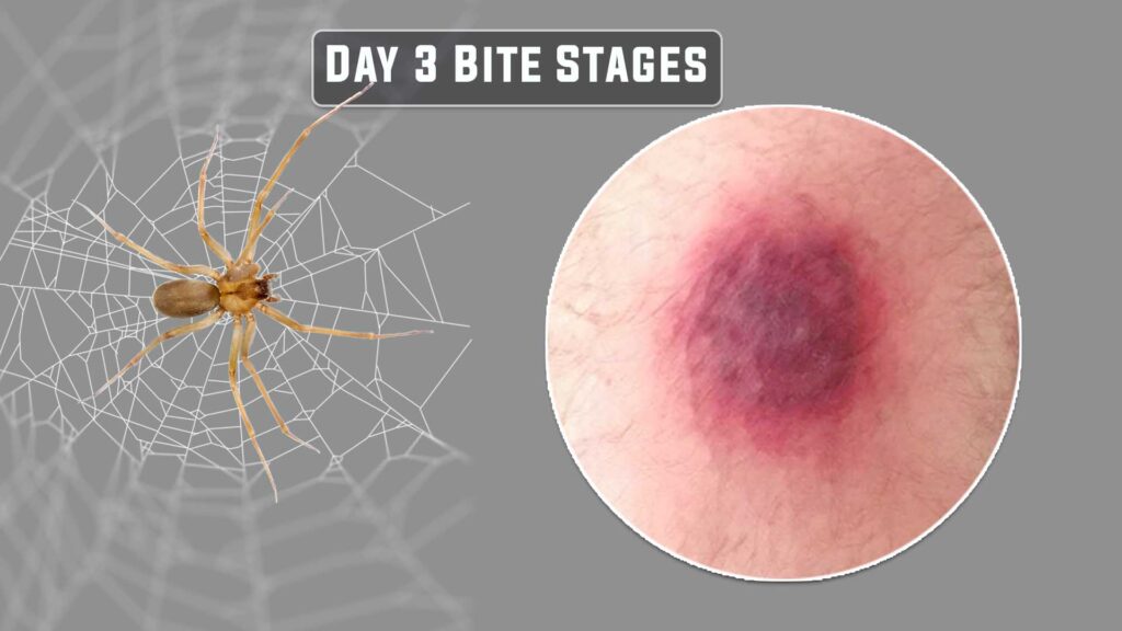 day 3 brown recluse bite stages