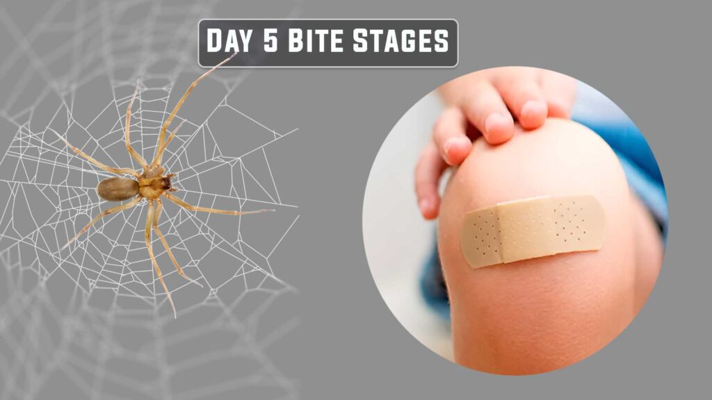 Day 5 brown recluse bite Recovery stages