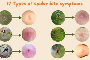 spider bite symptoms