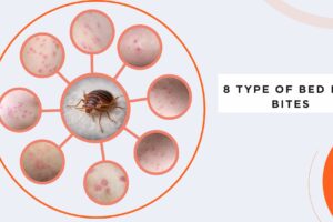 8 Type Of  Bed Bug Bites Identification Chart with Picture