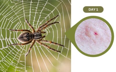 Wolf Spider Bite: Stages and Symptoms with Pictures