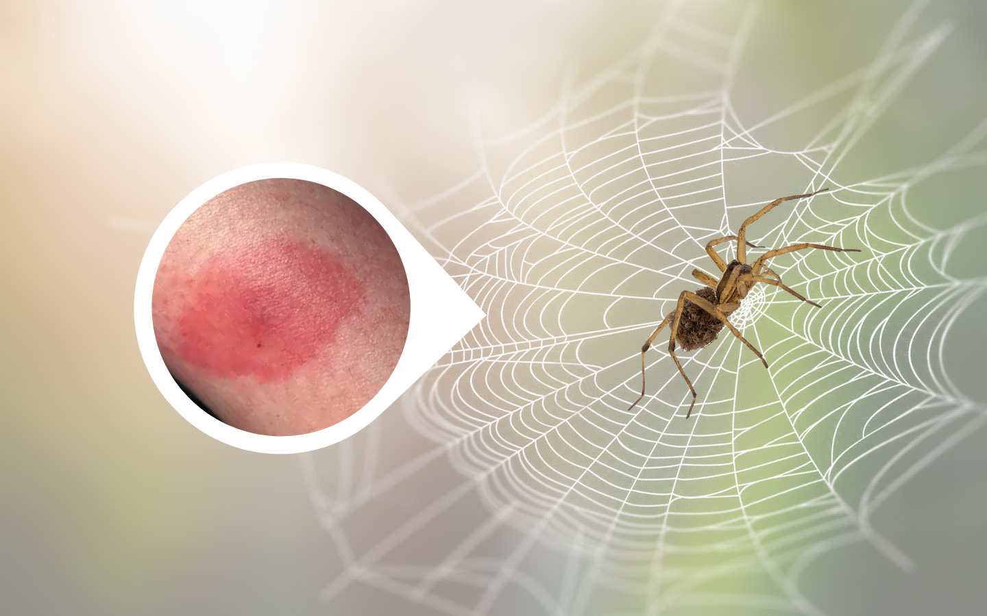 Black Widow Spider Bite Stages Symptoms With Pictures Identification 