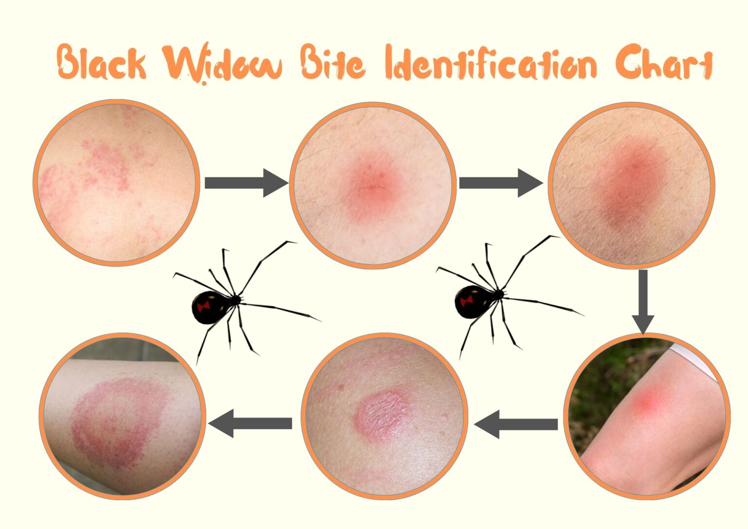Black Widow Spider Bite Stages Symptoms With Pictures Identification 