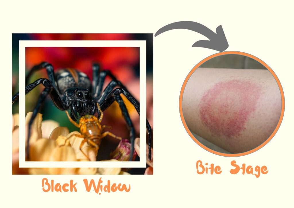 Black Widow Spider Bite Stage Day 3