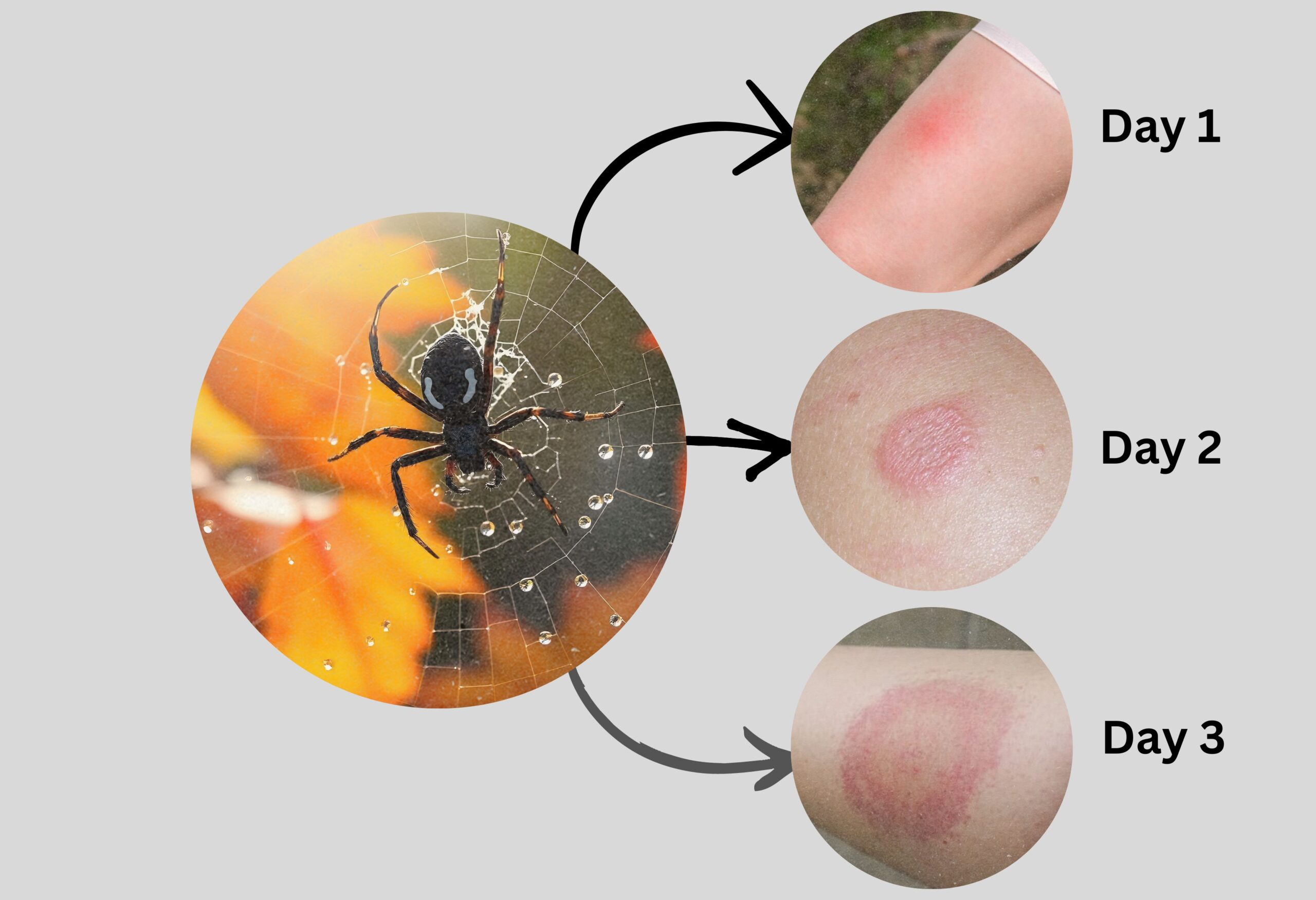 Black Widow Spider Bite Stages, Symptoms with Pictures (Identification)