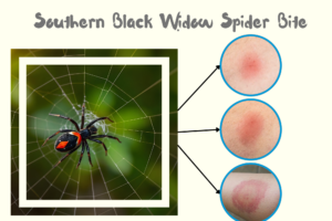 Southern Black Widow Spider Bite