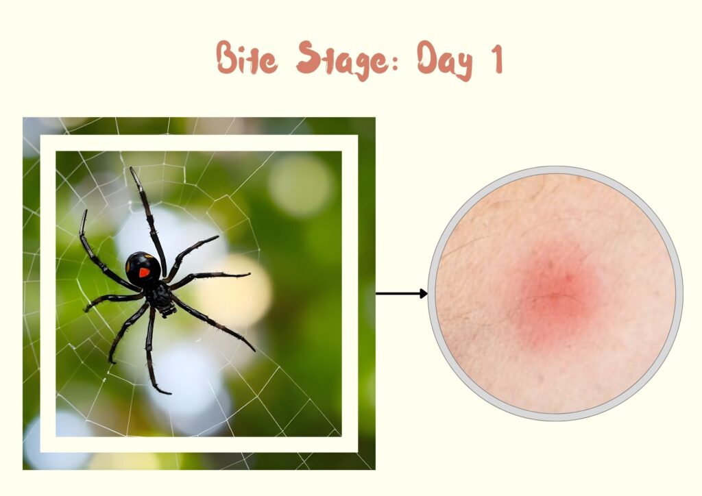 southern black Widow spider bite stage first day 