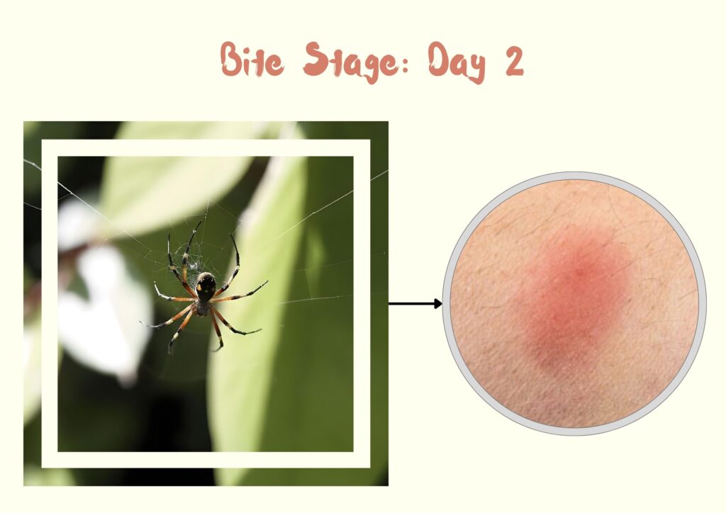 Southern black widow spider bite stage second day 