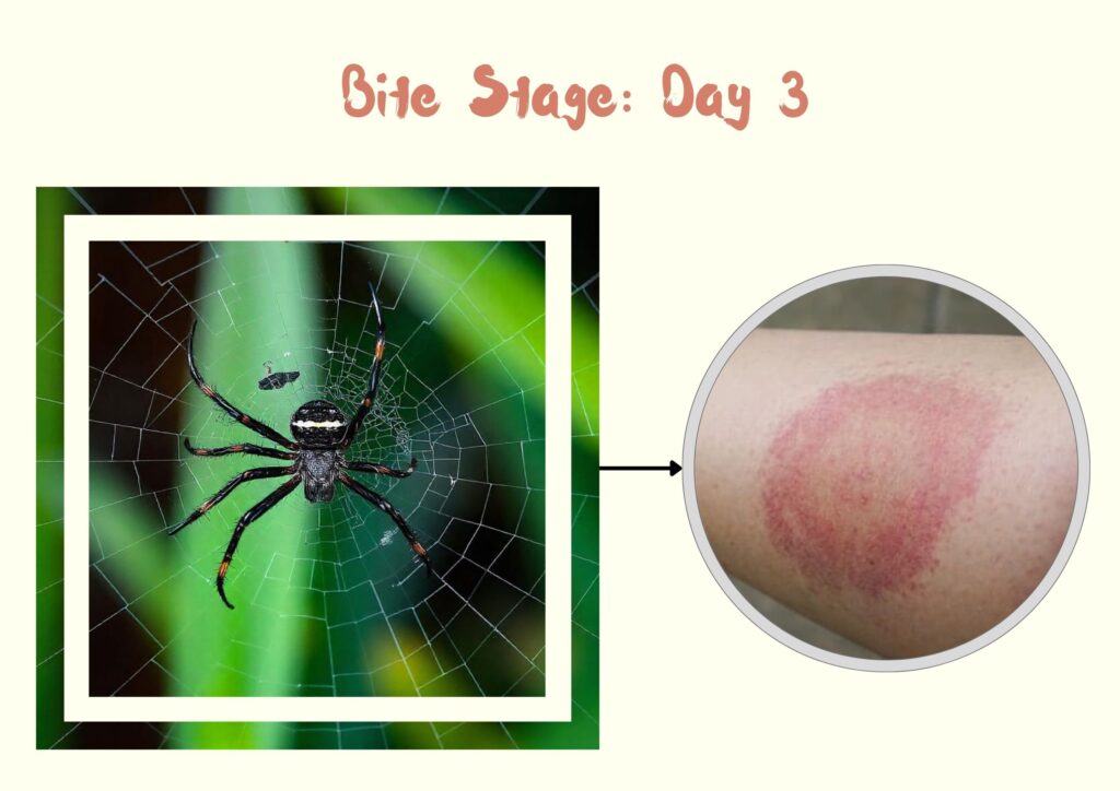 southern black widow spider bite stage third days