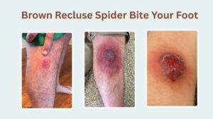 Brown Recluse Spider Bite: Identification with Pictures