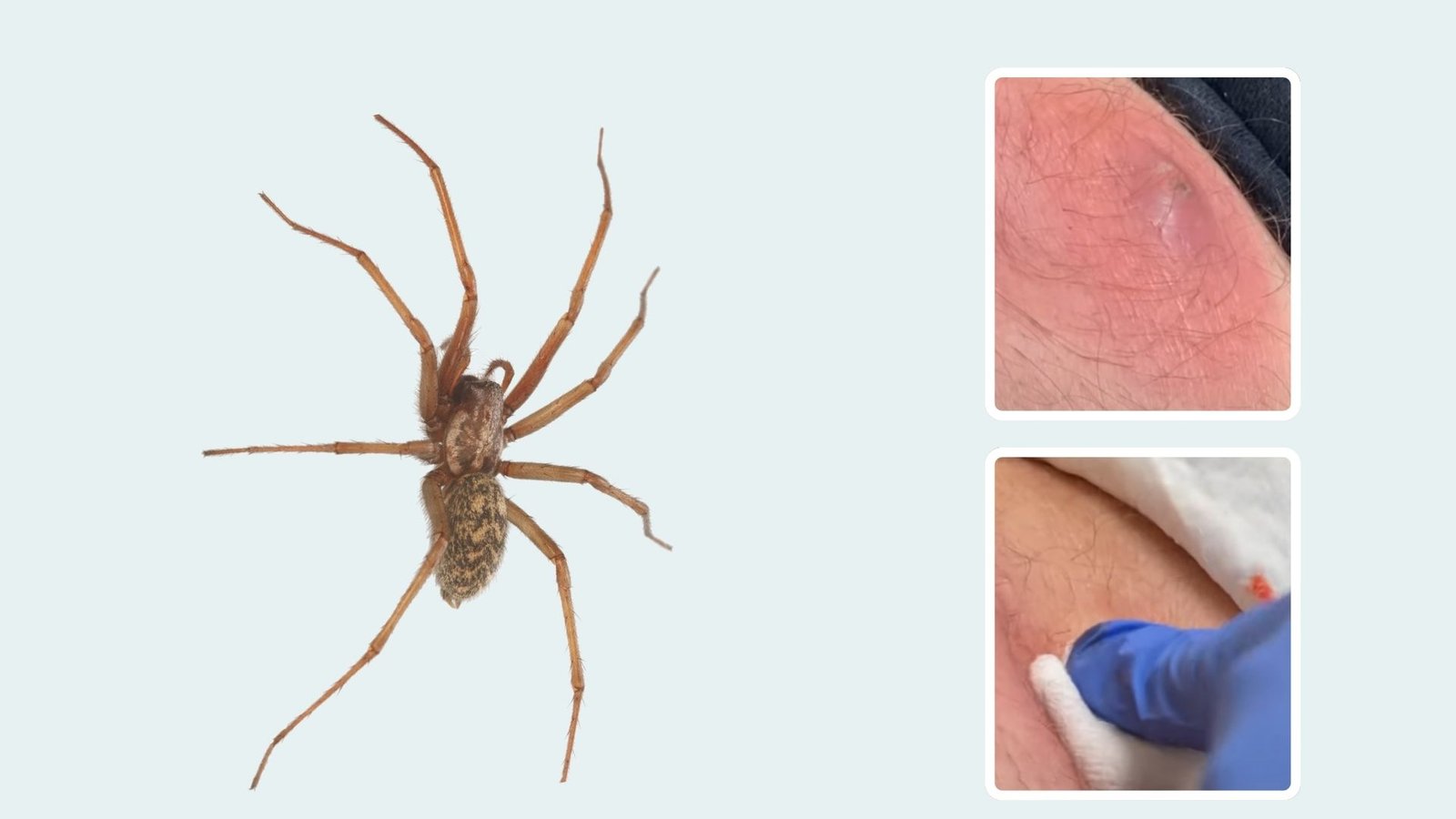 Brown Recluse Spider Bite Identification With Pictures