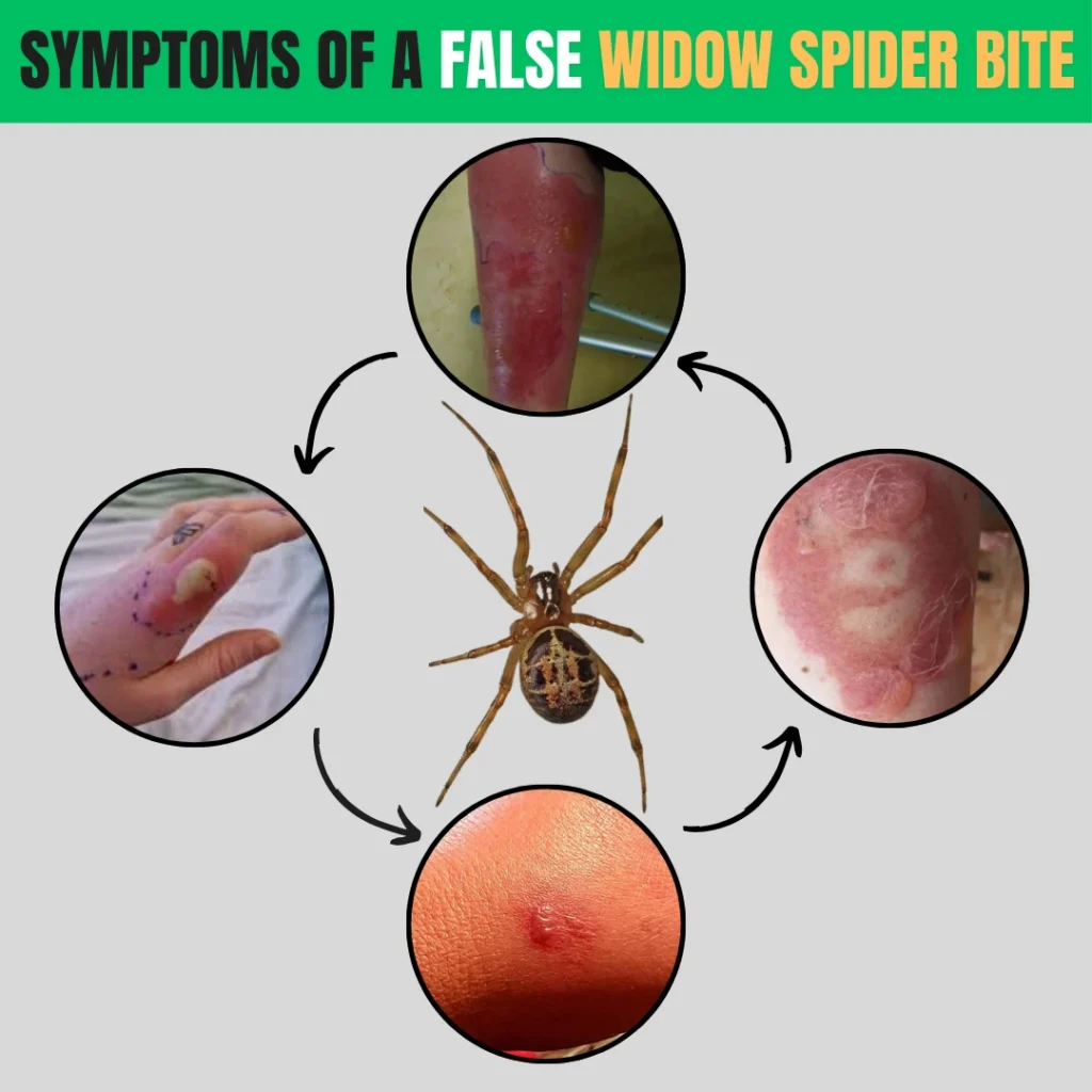 7 Symptoms Of False Widow Spider Bite Identification By Pic 7 Symptoms Of False Widow Spider Bite Identification By Pic