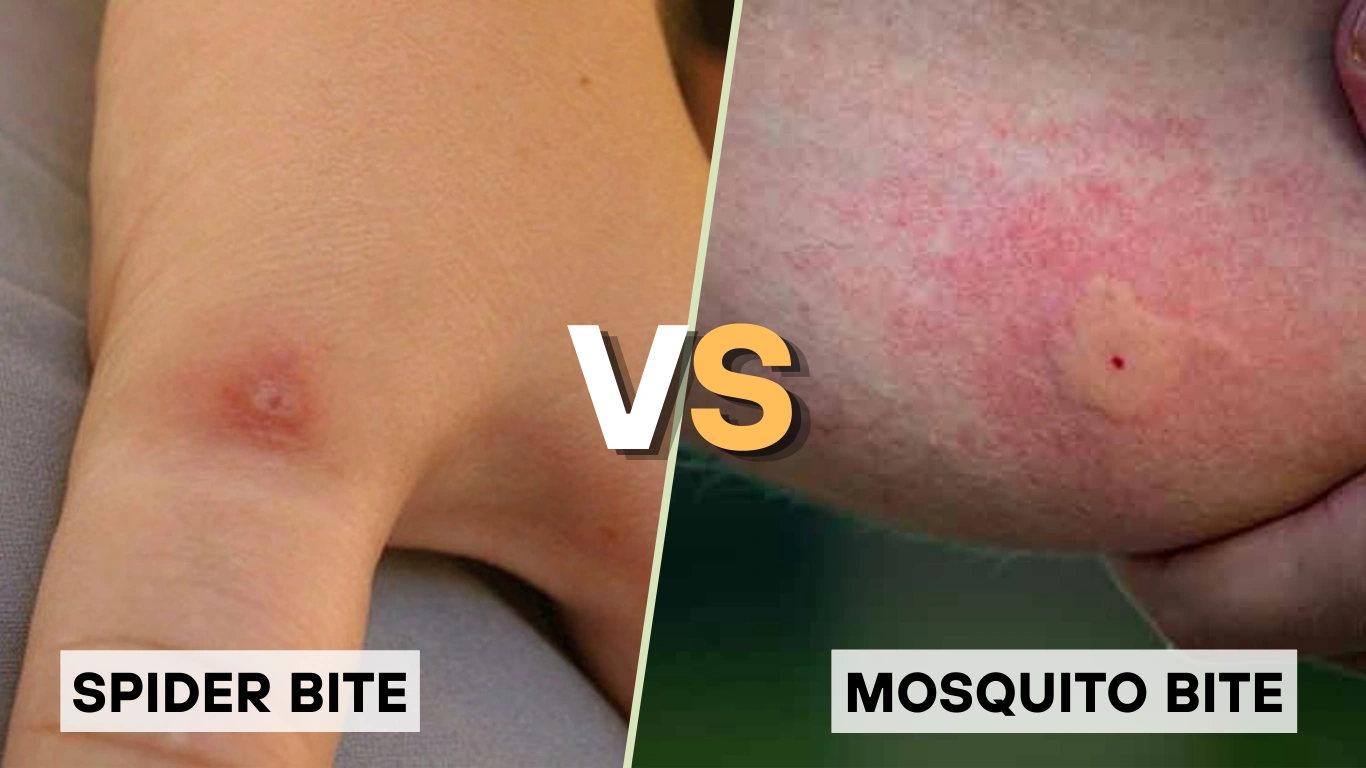 Spider Bite Vs Mosquito Bite Pictures How To Tell What Actually Bit 