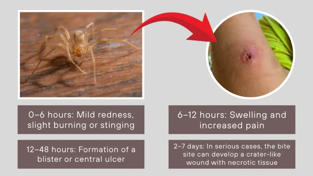 Brown Recluse Spider Bite Symptoms